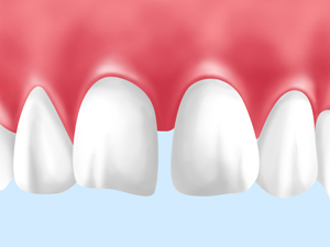 前歯の歯並びやすきっ歯が気になる方へ―矯正せずに手軽に治したい！
