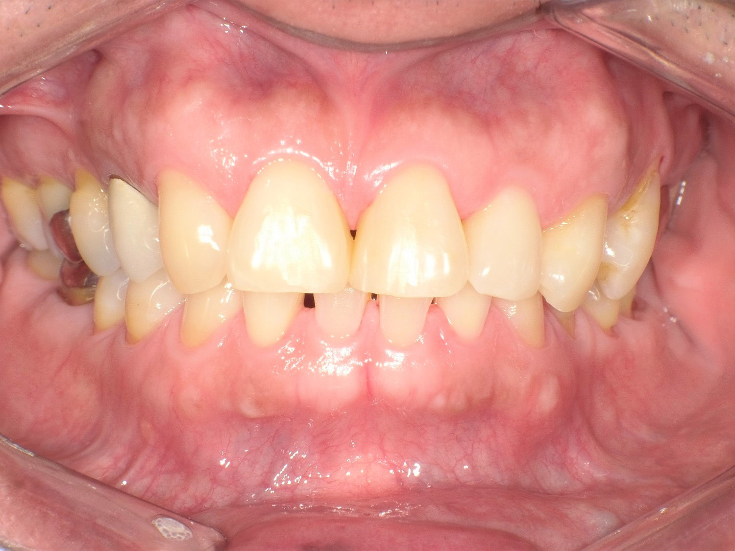 ダイレクトボンディングを使用したすきっ歯の治療例（2）