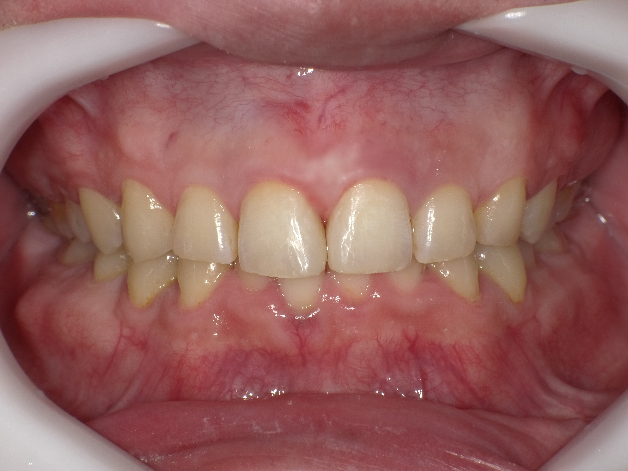 ダイレクトボンディングを使用したすきっ歯の治療例（2）
