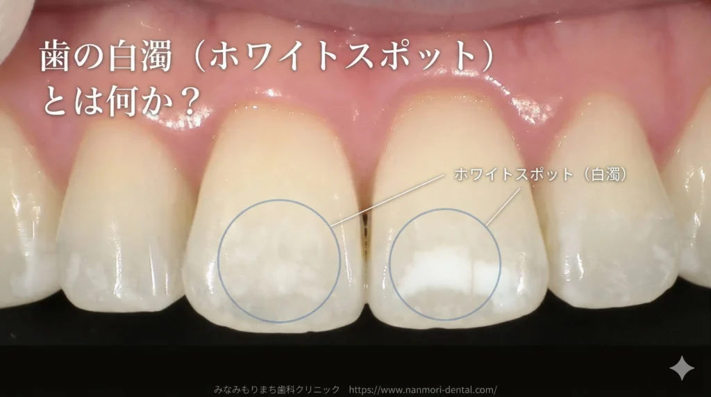 歯の白濁（ホワイトスポット）とは何か？