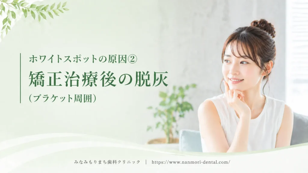ホワイトスポットの原因②矯正治療後の脱灰（ブラケット周囲）