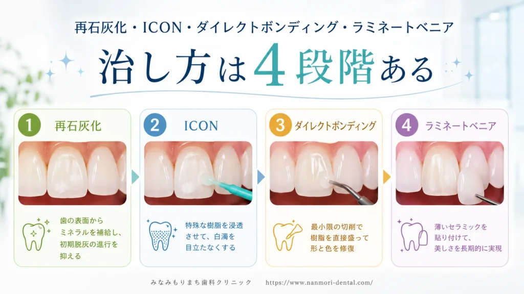 ホワイトスポットの治し方｜再石灰化・ICON・ボンディング・ベニアの全体像