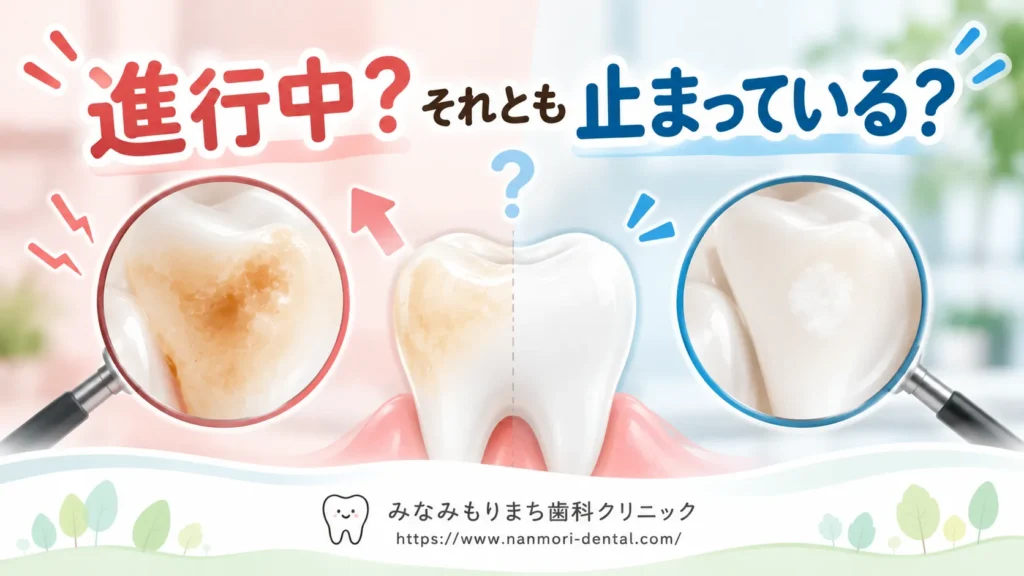 歯の脱灰が進んでいるか、止まっているかの見分け方